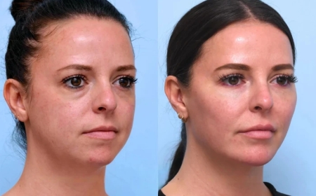 Before and After Thread Lift Results by the Best Plastic Surgeon in Dubai