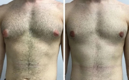 Gynecomastia in Dubai: A Complete Guide for Teenagers and Adults