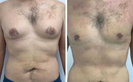 What is the Healing Process Like After Gynecomastia Surgery in Dubai?