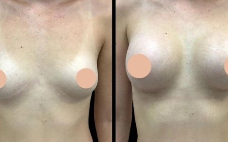 Safety First: What Makes the Best Breast Augmentation Surgeon in Dubai Stand Out