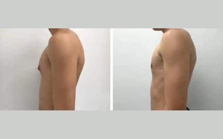 Expertise of the Best Doctors in Dubai for Gynecomastia Treatment