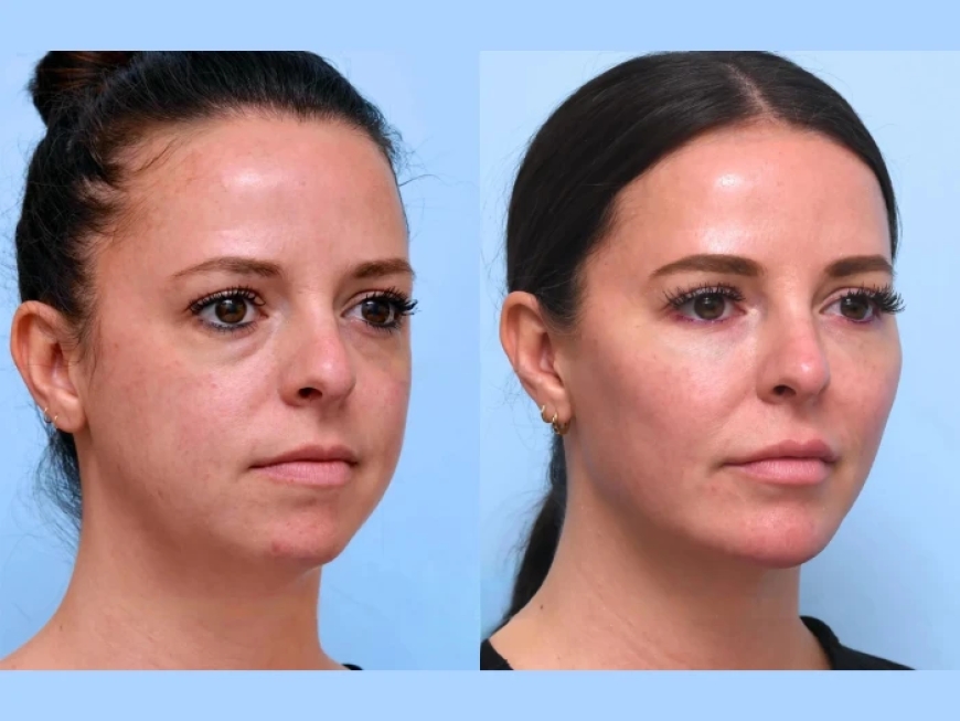 Who Is the Ideal Candidate for a Thread Lift in Dubai