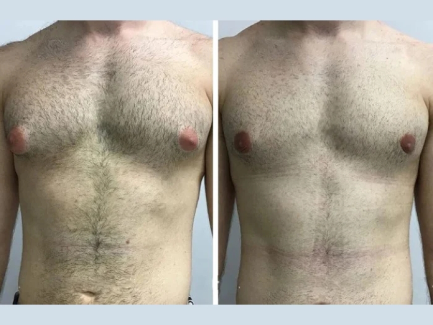 Gynecomastia in Dubai: A Complete Guide for Teenagers and Adults