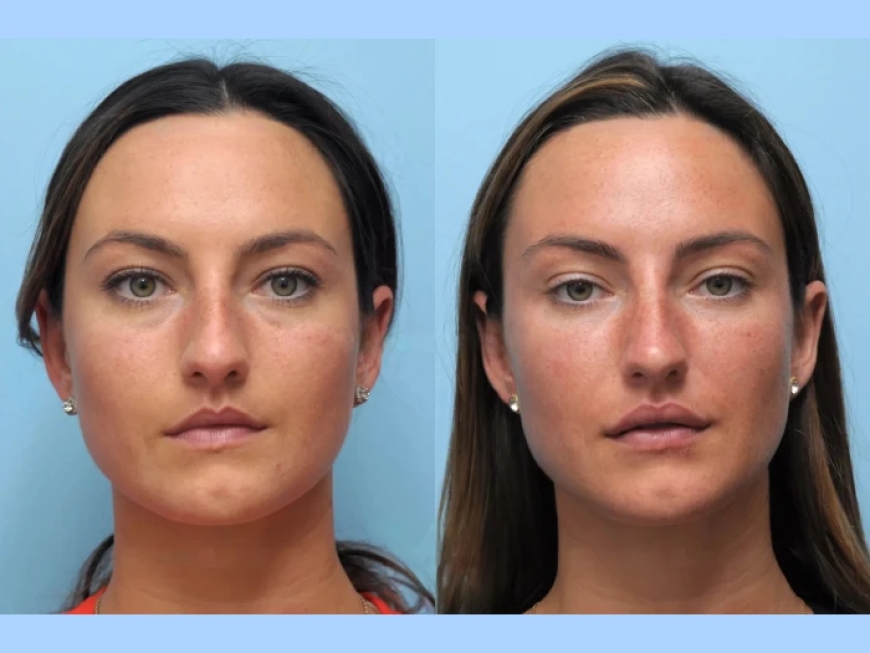 Your Personal Beauty Upgrade: Thread Lift in Dubai Explained