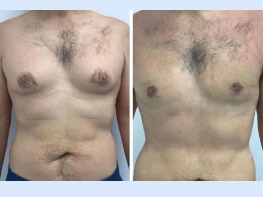 What is the Healing Process Like After Gynecomastia Surgery in Dubai?