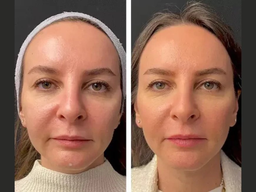 What to Expect from a Mesotherapy Session with the Best Plastic Surgeons in Dubai