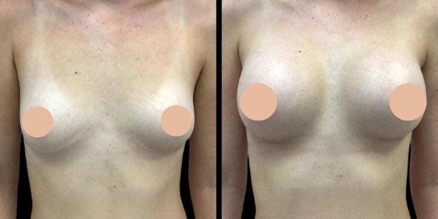 Safety First: What Makes the Best Breast Augmentation Surgeon in Dubai Stand Out