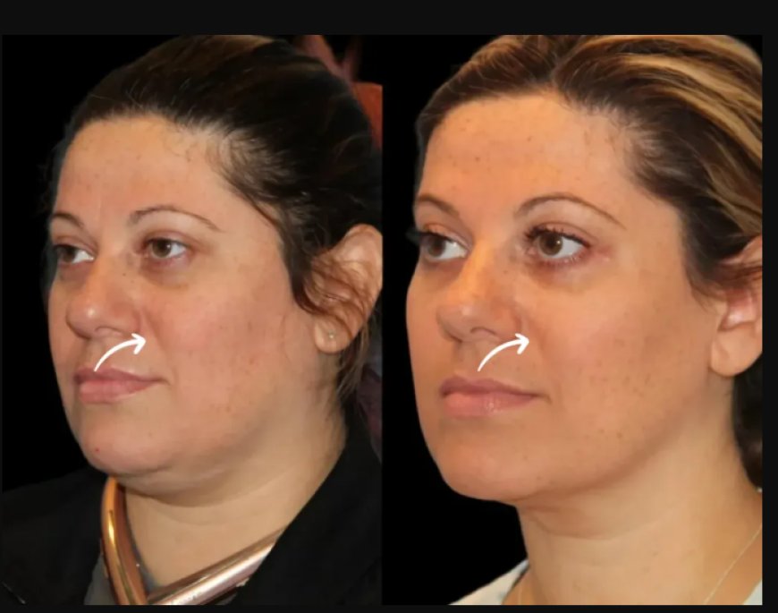 Summer-Ready with Sculptra Fillers: Tips from the Best Plastic Surgeon in Dubai