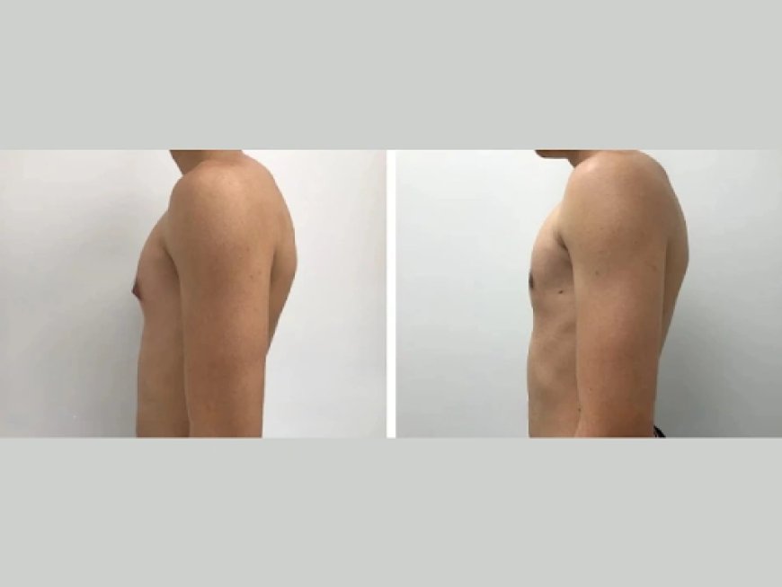 Qualifications to Look for in the Best Gynecomastia Surgeons in Dubai