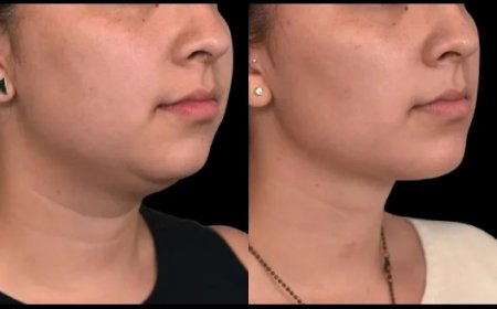 Double Chin Removal for Athletes: How the Best Double Chin Removal Surgeon in Dubai Can Help You Stay in Shape