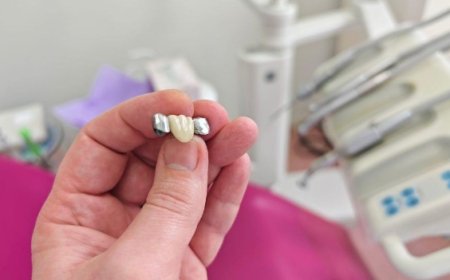 Protect Your Smile — The Importance of Dental Crowns in Oshawa 