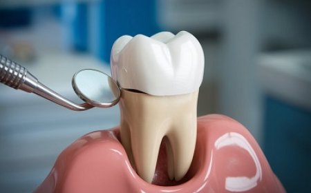 Best Dental Crown Options for Tooth Repair