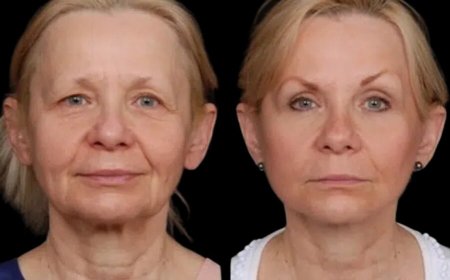 The Best Doctors in Dubai for Under Eye Fillers: A Solution to Your Tired Eyes