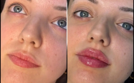 Can the Best Doctors in Dubai Help You Get the Perfect Fillers Look?