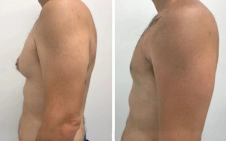 The Best Gynecomastia Surgeons in Dubai: What You Should Know About Their Expertise