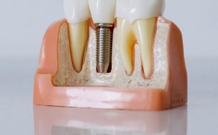 Protect Neighboring Teeth with Dental Implants