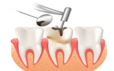 Root Canal Treatment Cost: What to Expect and How to Budget