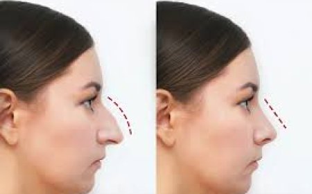 Balancing Beauty: The Rise of Rhinoplasty in Modern Aesthetics