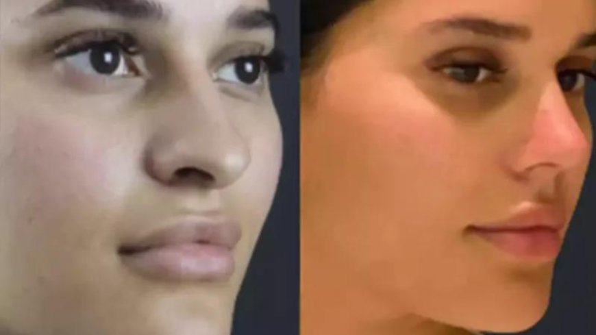 Minimally Invasive Rhinoplasty in Dubai: What’s New?