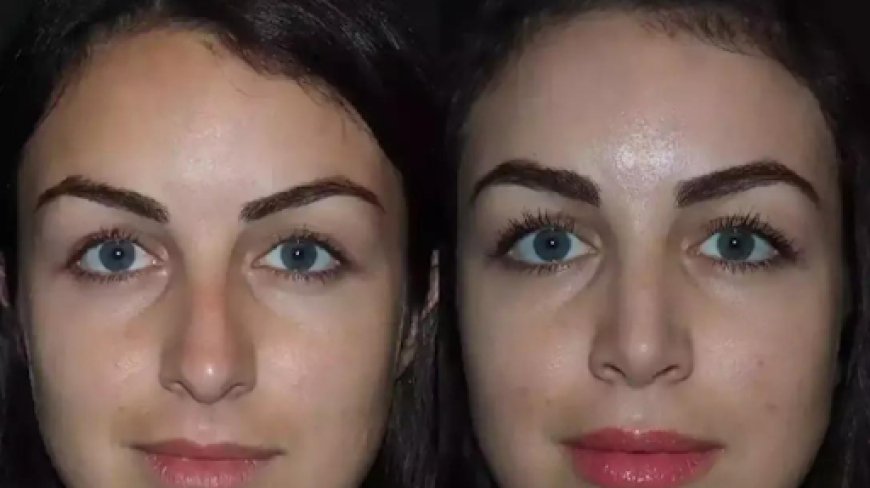 Septoplasty in Dubai: What Makes It So Effective?