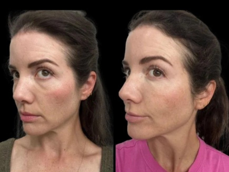 Best Aesthetic Clinics in Dubai Using Microneedling for Dark Circles Treatment
