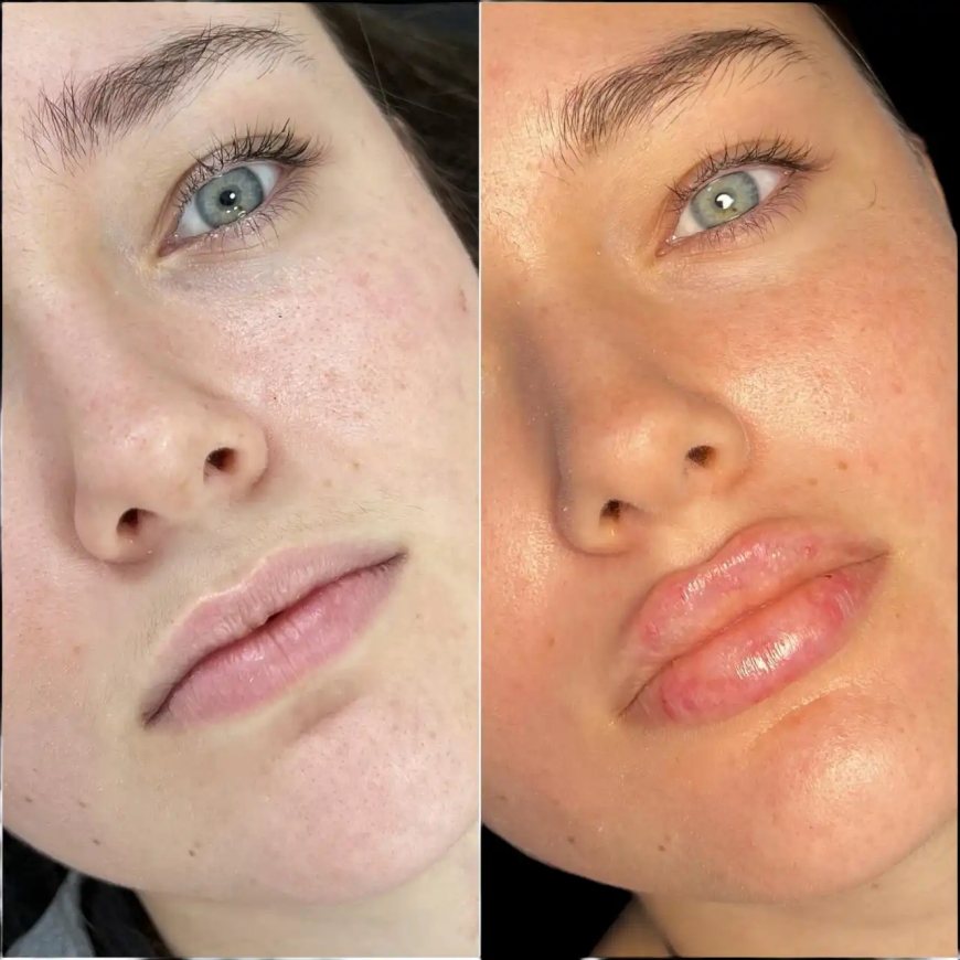Safe and Effective Fillers Treatment in Dubai