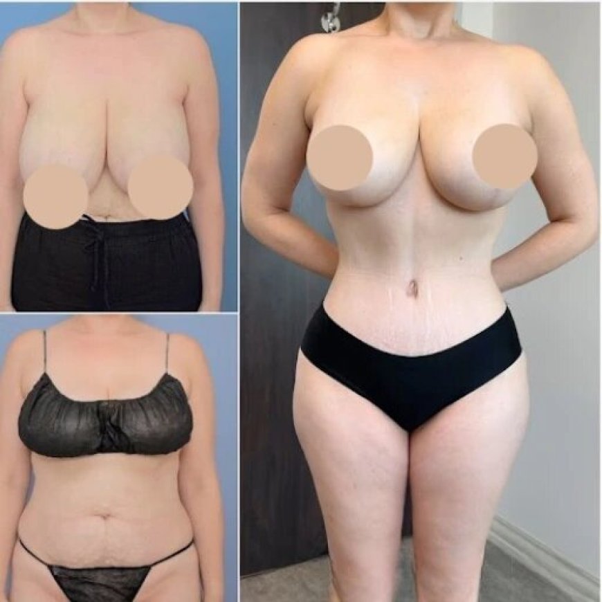 What to Know Before Choosing a Best Tummy Tuck Surgeon in Dubai