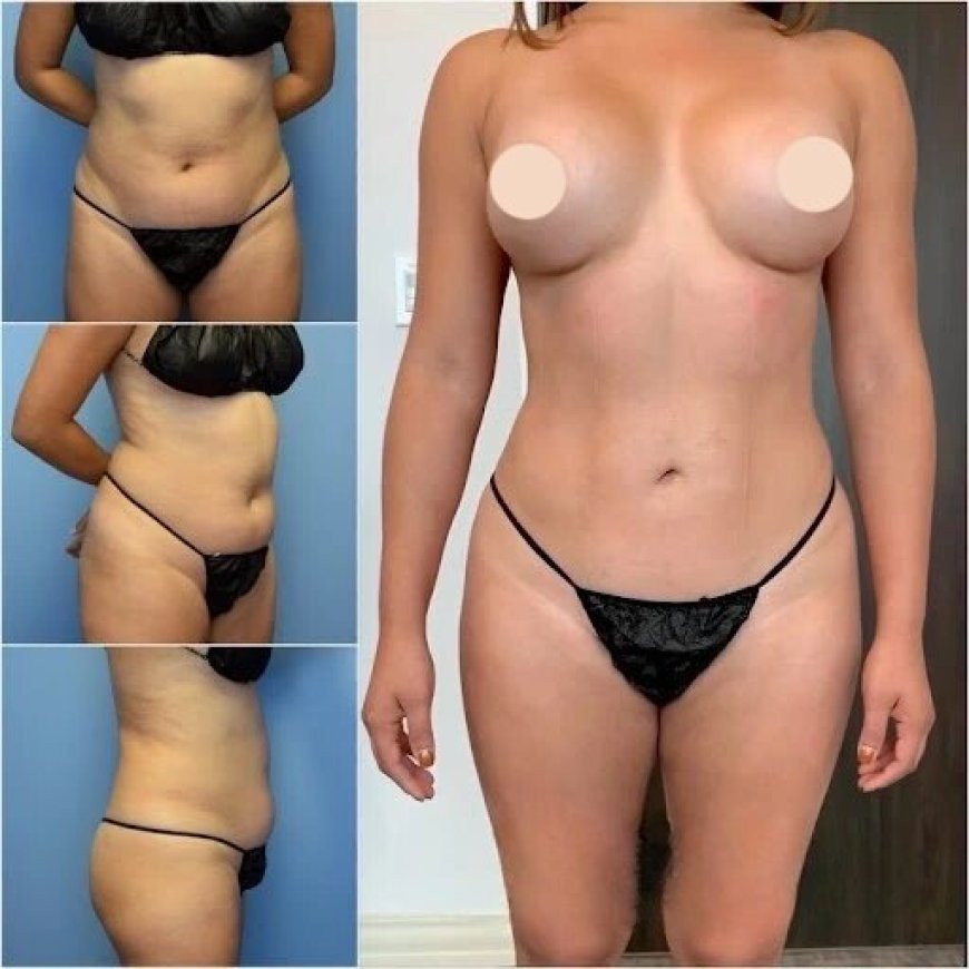 Discover How the Best Body Contouring Surgeon in Dubai Achieves Best Results