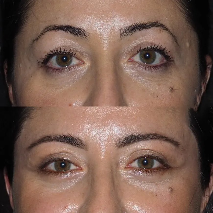 How to Prepare for Surgery: Tips from the Best Eye Bag Removal Surgeon in Dubai