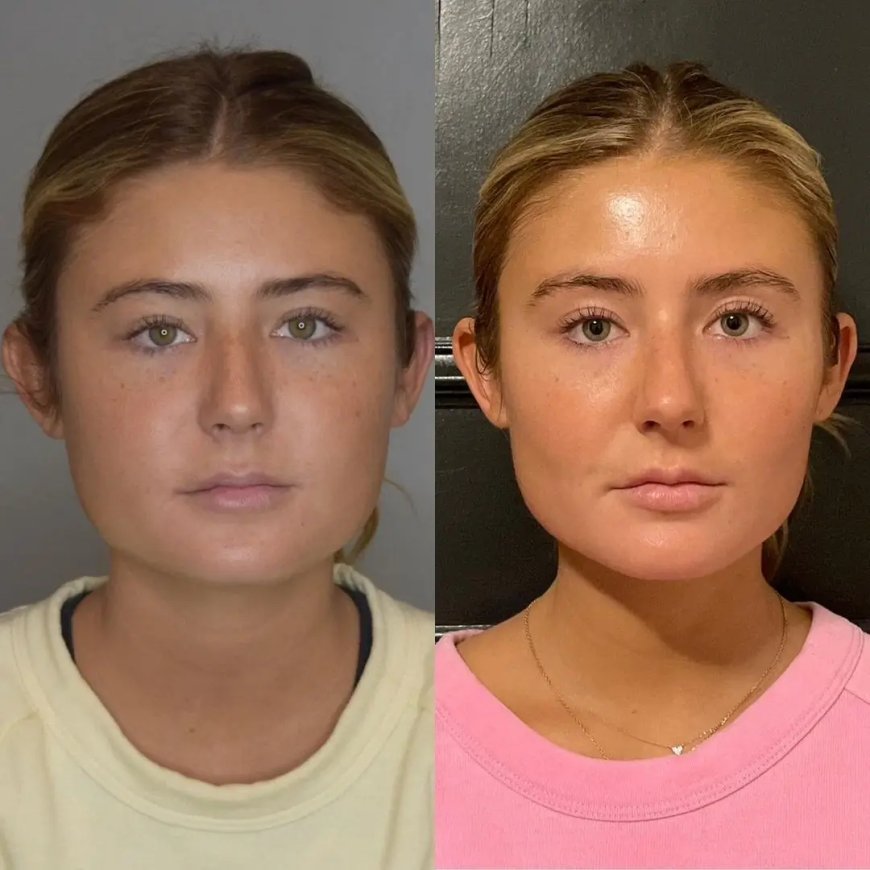 What Makes the Best Results in Buccal Fat Removal? Insights from the Best Buccal Fat Removal Surgeon in Dubai
