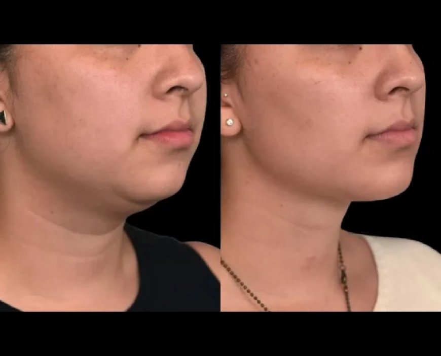 Double Chin Removal for Athletes: How the Best Double Chin Removal Surgeon in Dubai Can Help You Stay in Shape