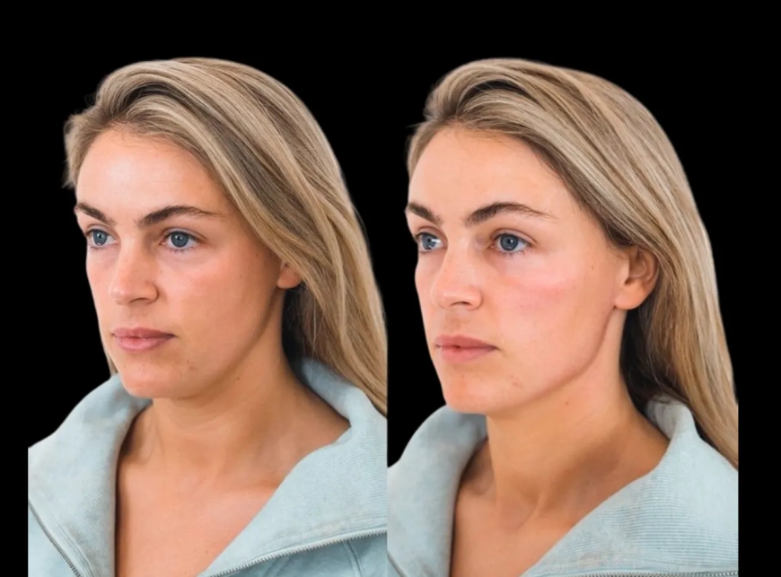 How to Find the Best Doctors in Dubai for Cheek Fillers and Aesthetic Treatments