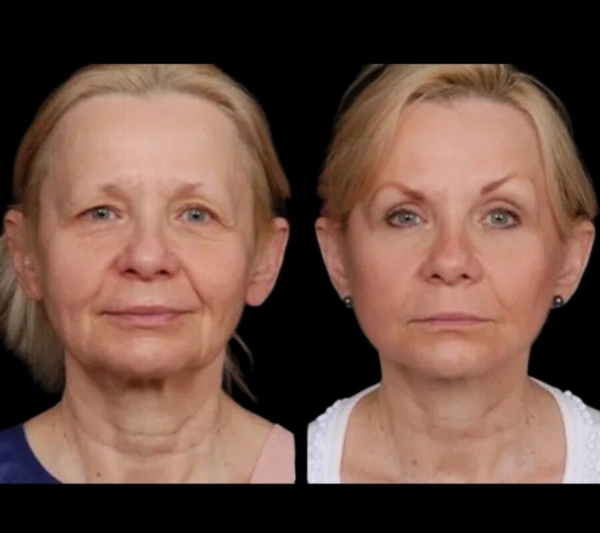 The Best Doctors in Dubai for Under Eye Fillers: A Solution to Your Tired Eyes