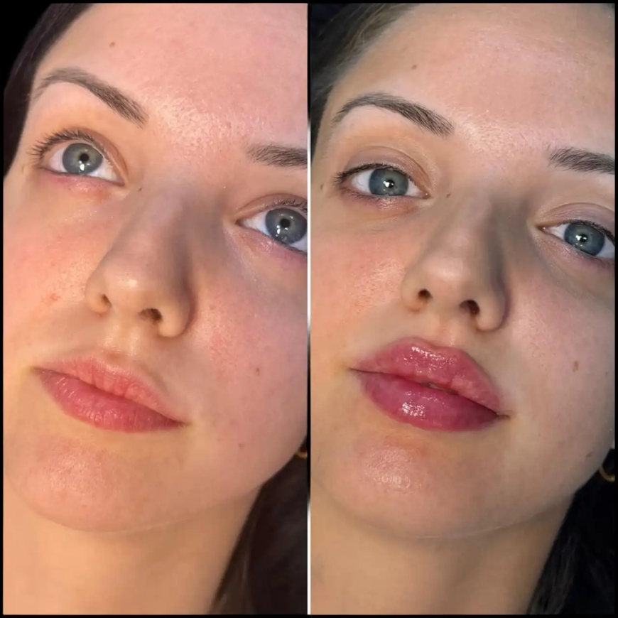 Can the Best Doctors in Dubai Help You Get the Perfect Fillers Look?