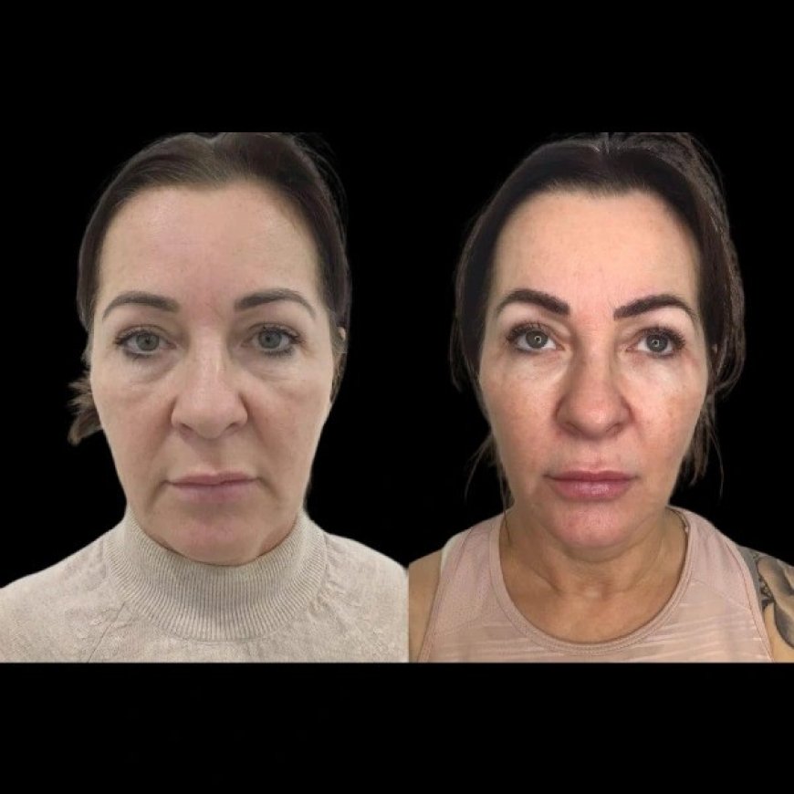 The Science Behind Profhilo Explained by the Best Doctors in Dubai