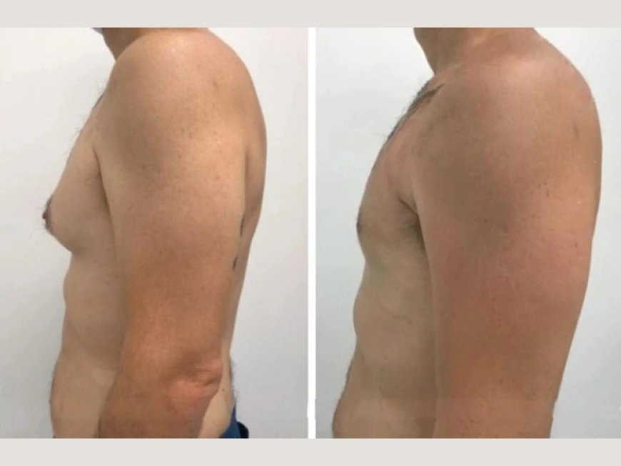 The Best Gynecomastia Surgeons in Dubai: What You Should Know About Their Expertise