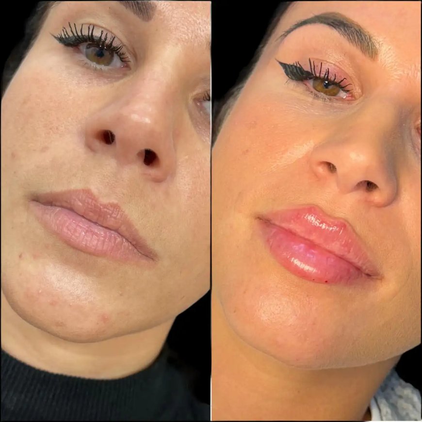 How the Best Aesthetic Clinics in Dubai Use Dermal Fillers for Facial Contouring