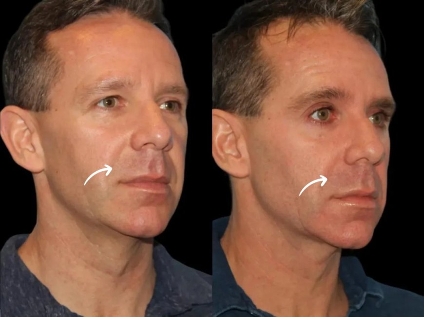 Best Plastic Surgeons in Dubai: Sculptra Fillers & Smoking