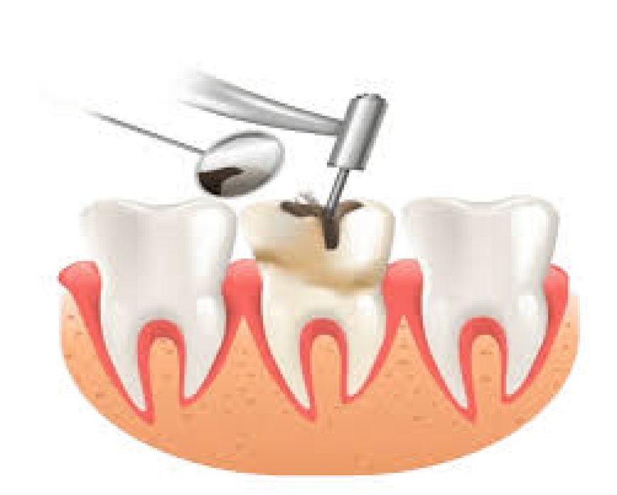 Root Canal Treatment Cost: What to Expect and How to Budget