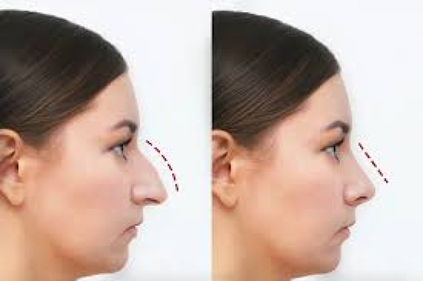Balancing Beauty: The Rise of Rhinoplasty in Modern Aesthetics